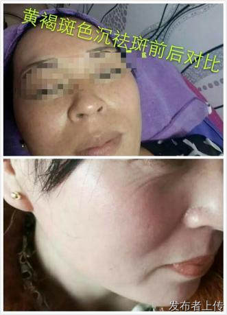 祛斑美白祛黄